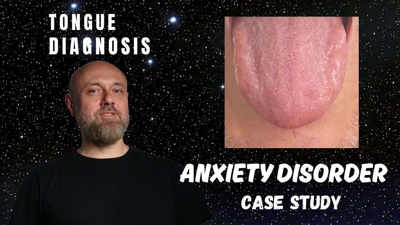 TCM Pattern Diagnosis: Treatment of Anxiety Disorder With Herbal Medicine