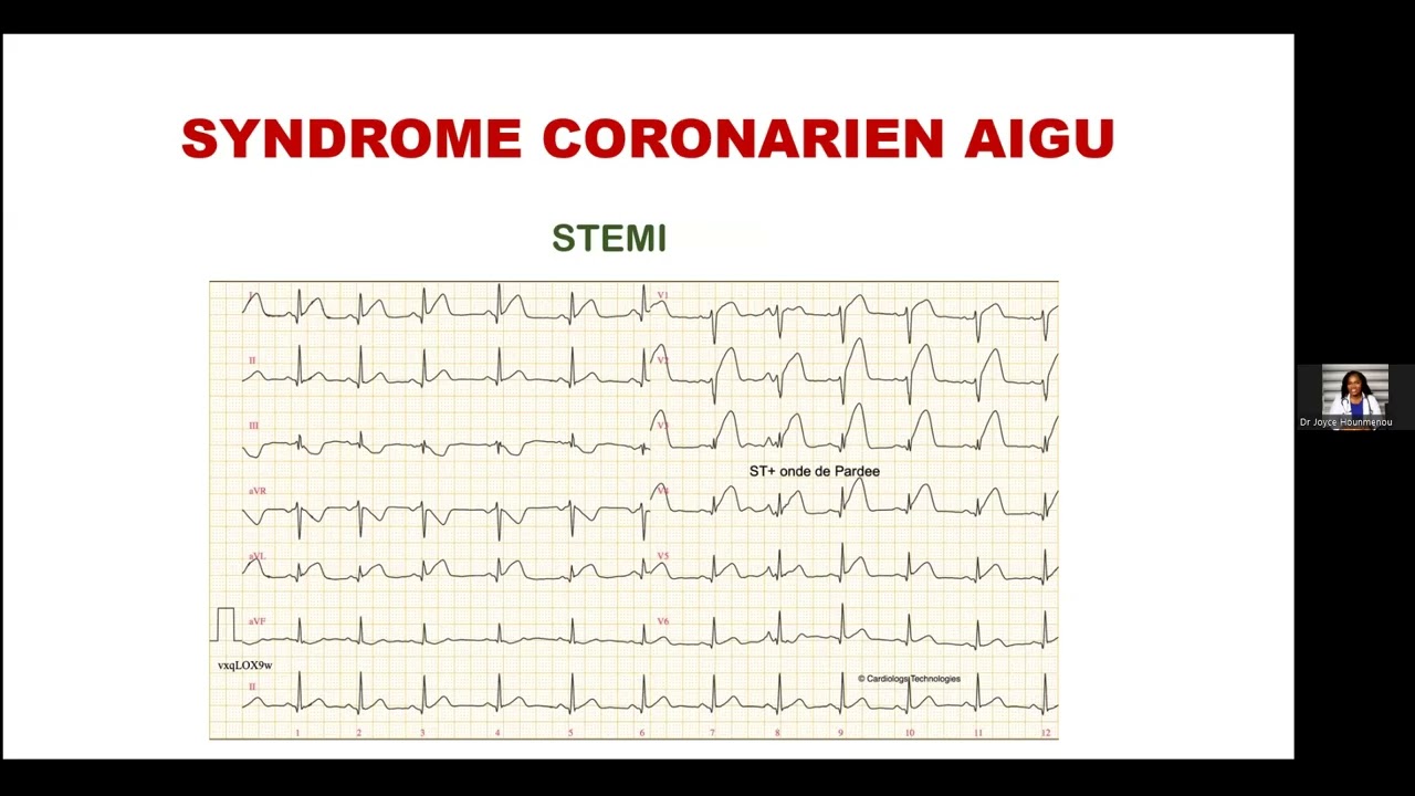 Syndrome coronarien aigu