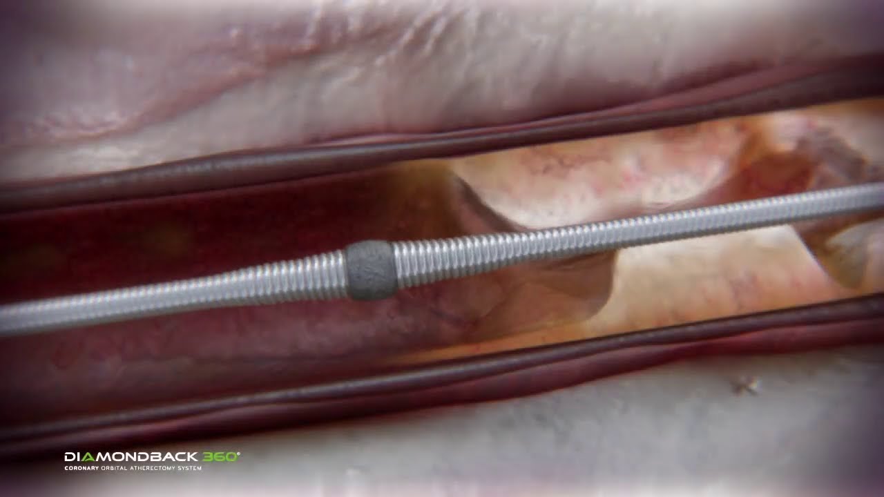 Coronary Orbital Atherectomy