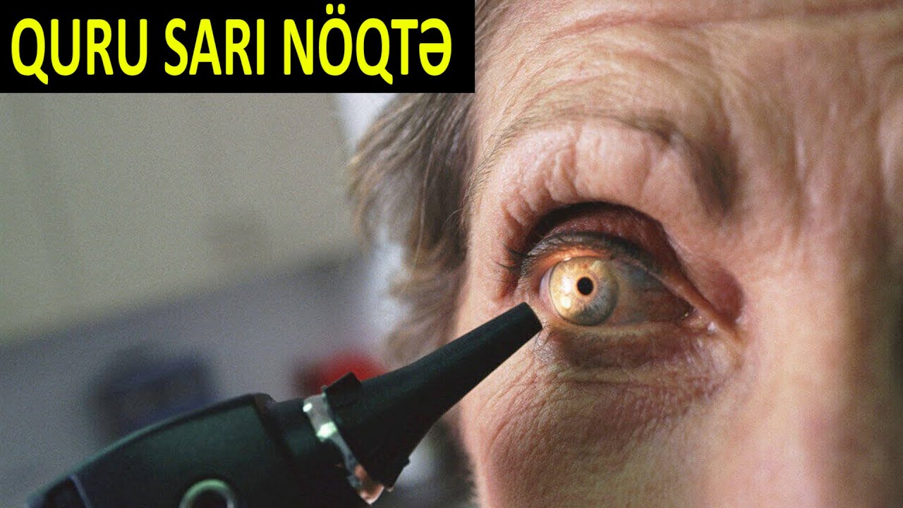 Gözdə quru sarı nöqtə - Müalicəsi varmı?