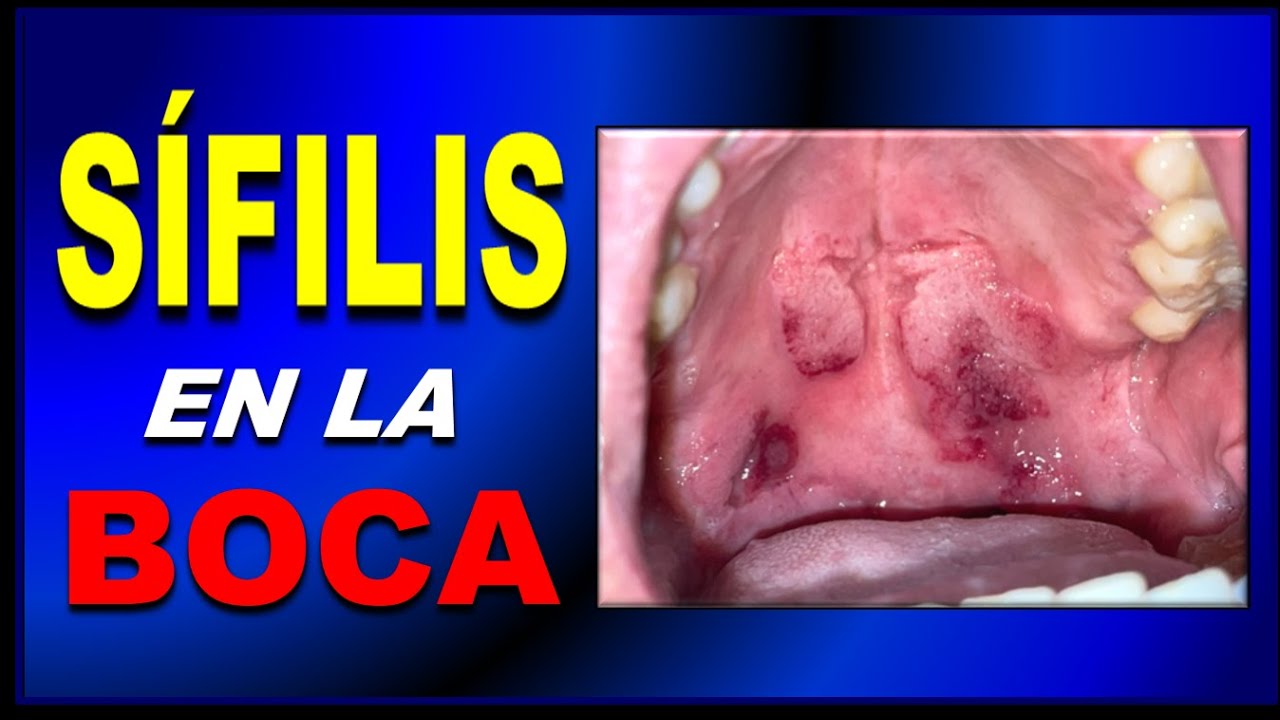S&Iacute;FILIS en la Boca: S&iacute;ntomas y Lesiones que Debes Conocer