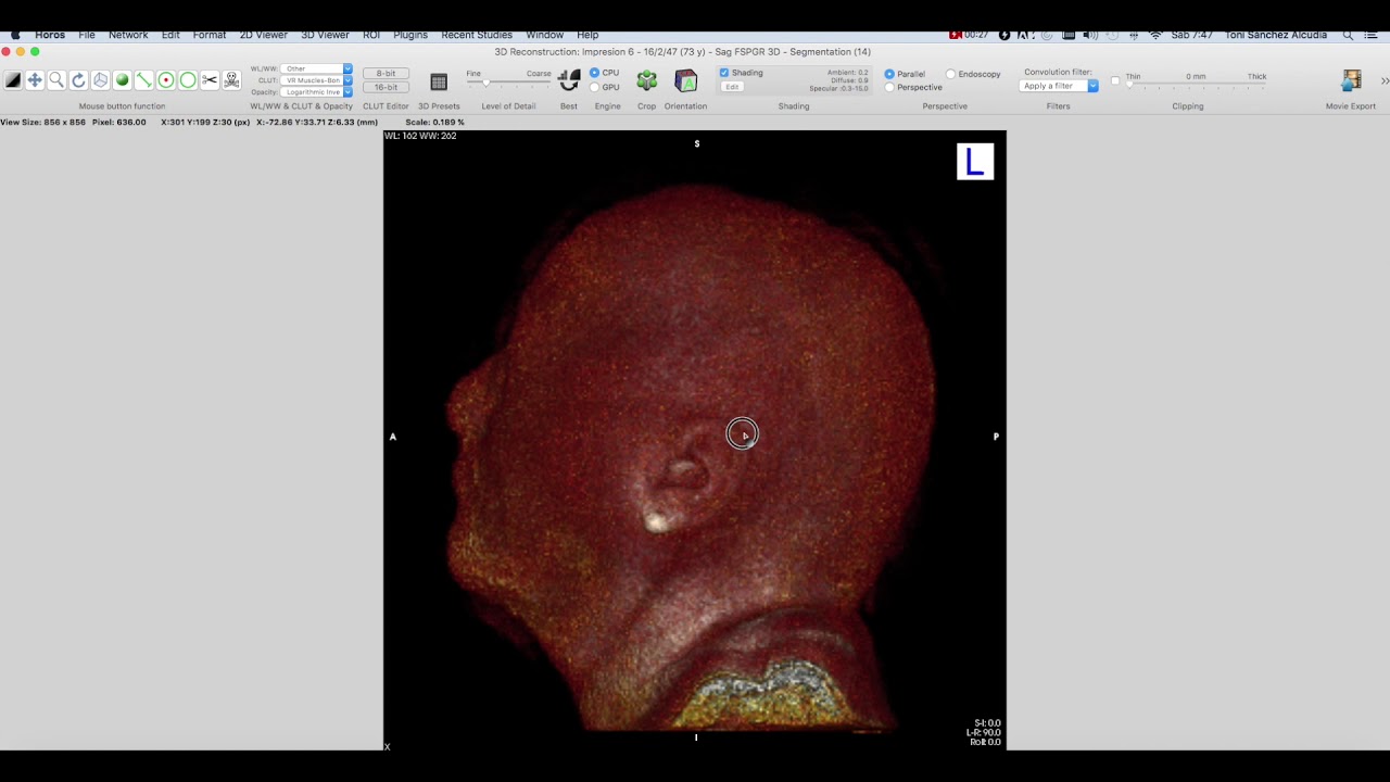 VISOR DICOM HOROS : OSIRIX 12 (Cálculo de volúmenes)
