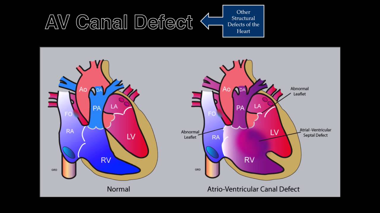 Fetal Echocardiography: AV Canal Defect