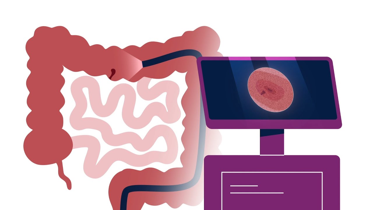 What is a Colonoscopy