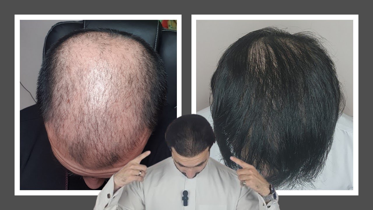 بعد سنتين من زراعة الشعر