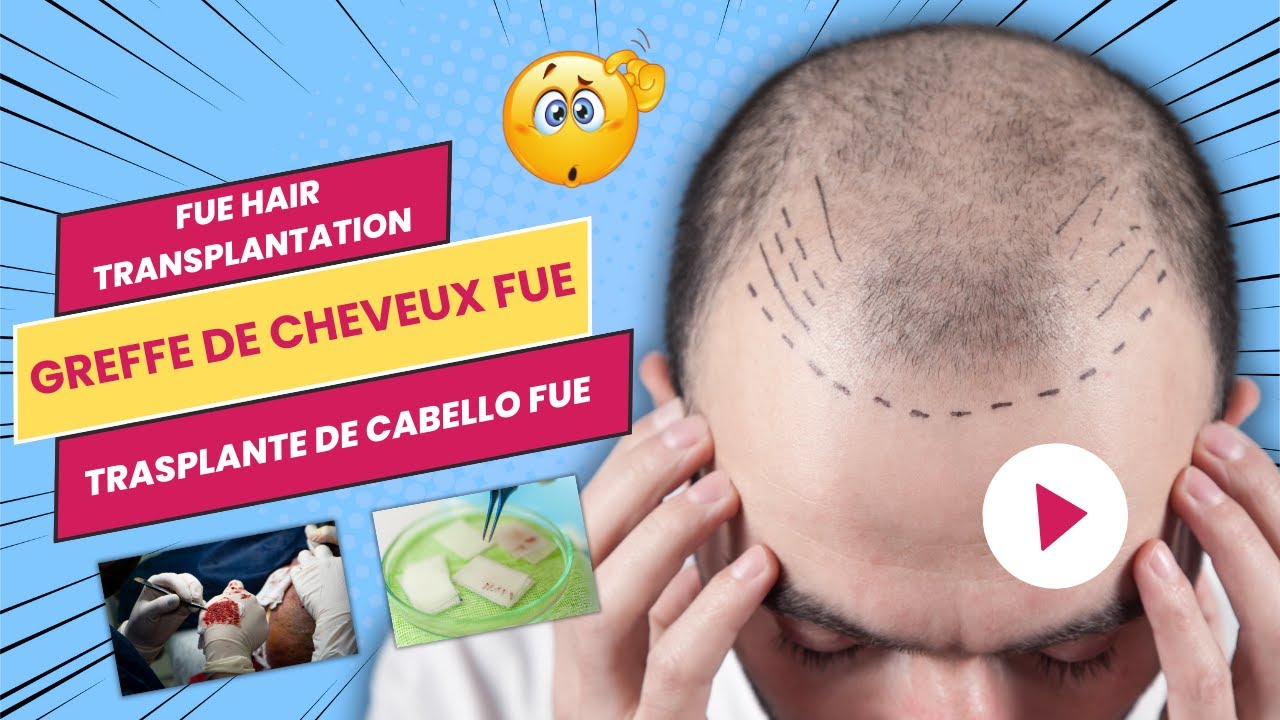 FUE HAIR TRANSPLANTATION | GREFFE DE CHEVEUX FUE | TRASPLANTE DE CABELLO FUE