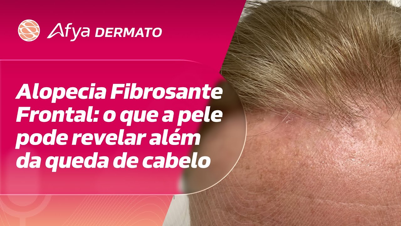 Alopecia Fibrosante Frontal: o que a pele pode revelar além da queda de cabelo