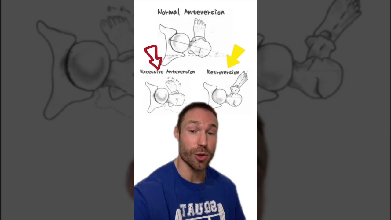 How to Squat For Your Anatomy (Toe Angle!)