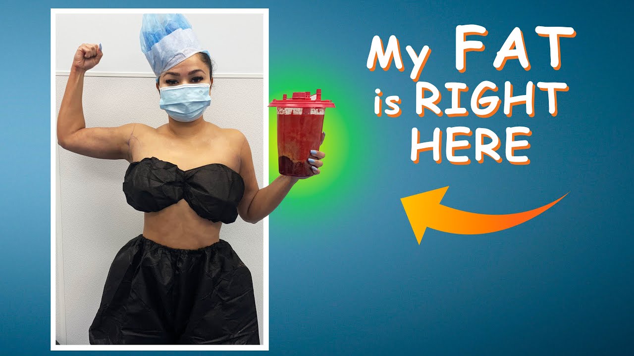 Arm Liposuction Immediate Results | High-Definition Lipo 360&deg; Arms | Celebrity Arms&trade;| Artlipo