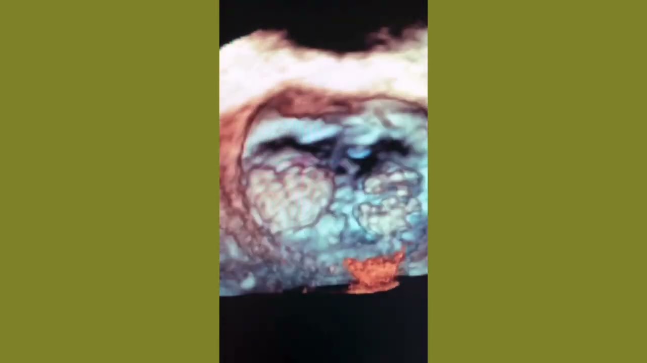 Mitral Valve Leaflets Aneurysm (3D TTE)
