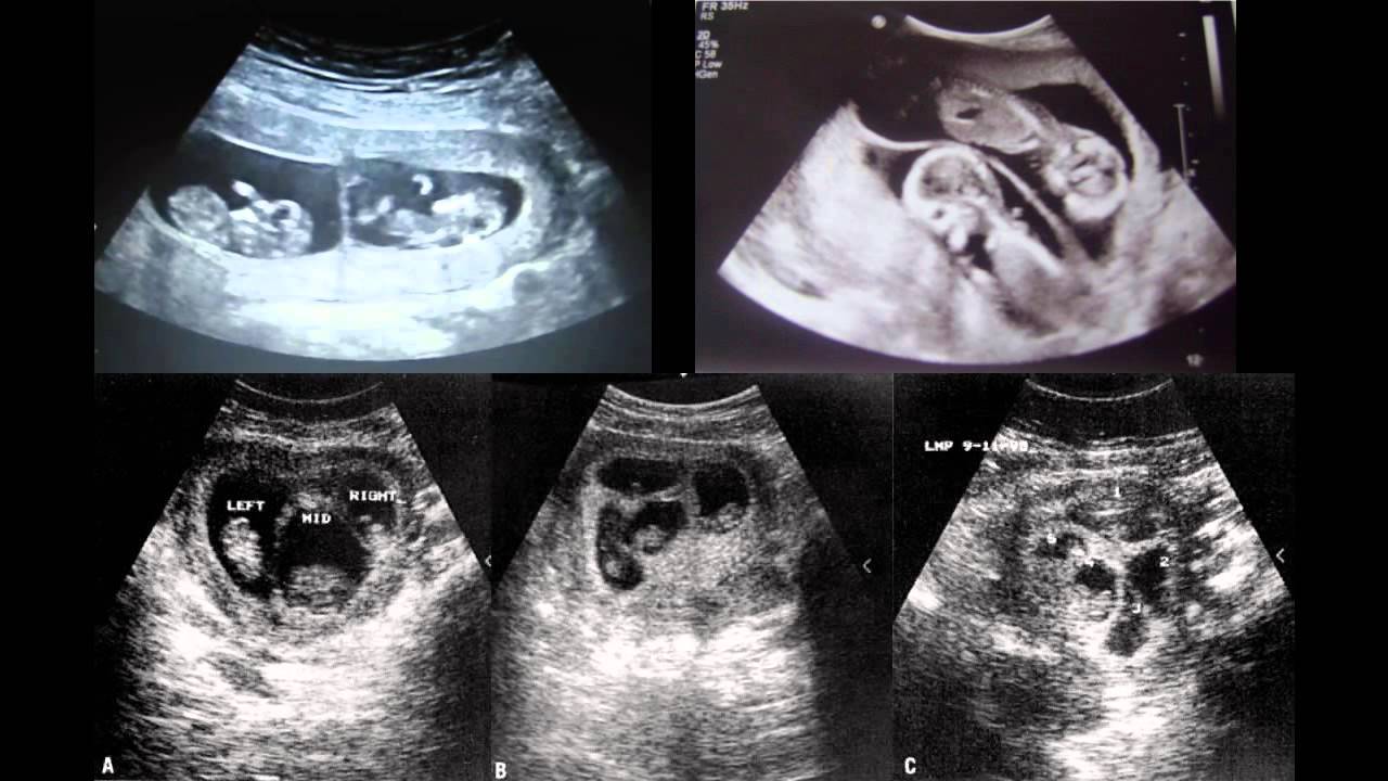 Intro to Later Pregnancy Ultrasound