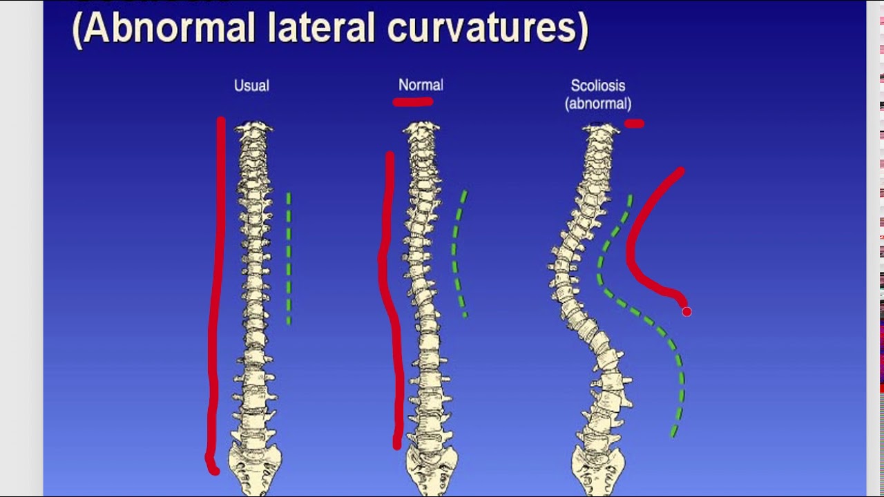 Scoliosis & Spinal Fusion Series