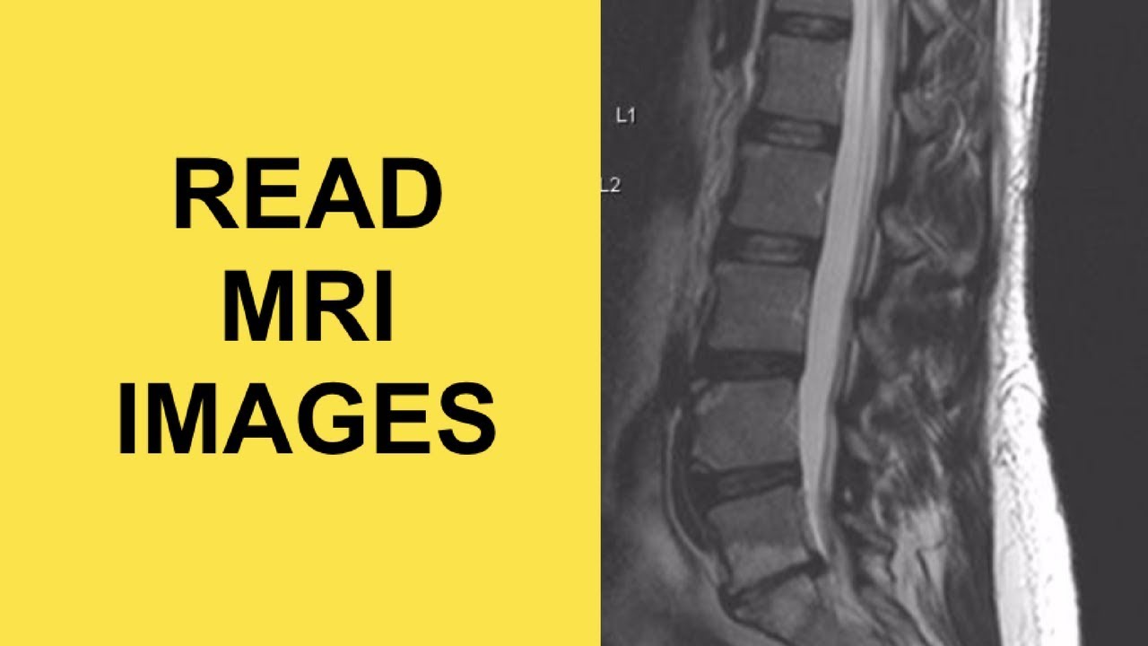 How to read an MRI of the lumbar spine for herniated discs (SCIATICA CAUSE)