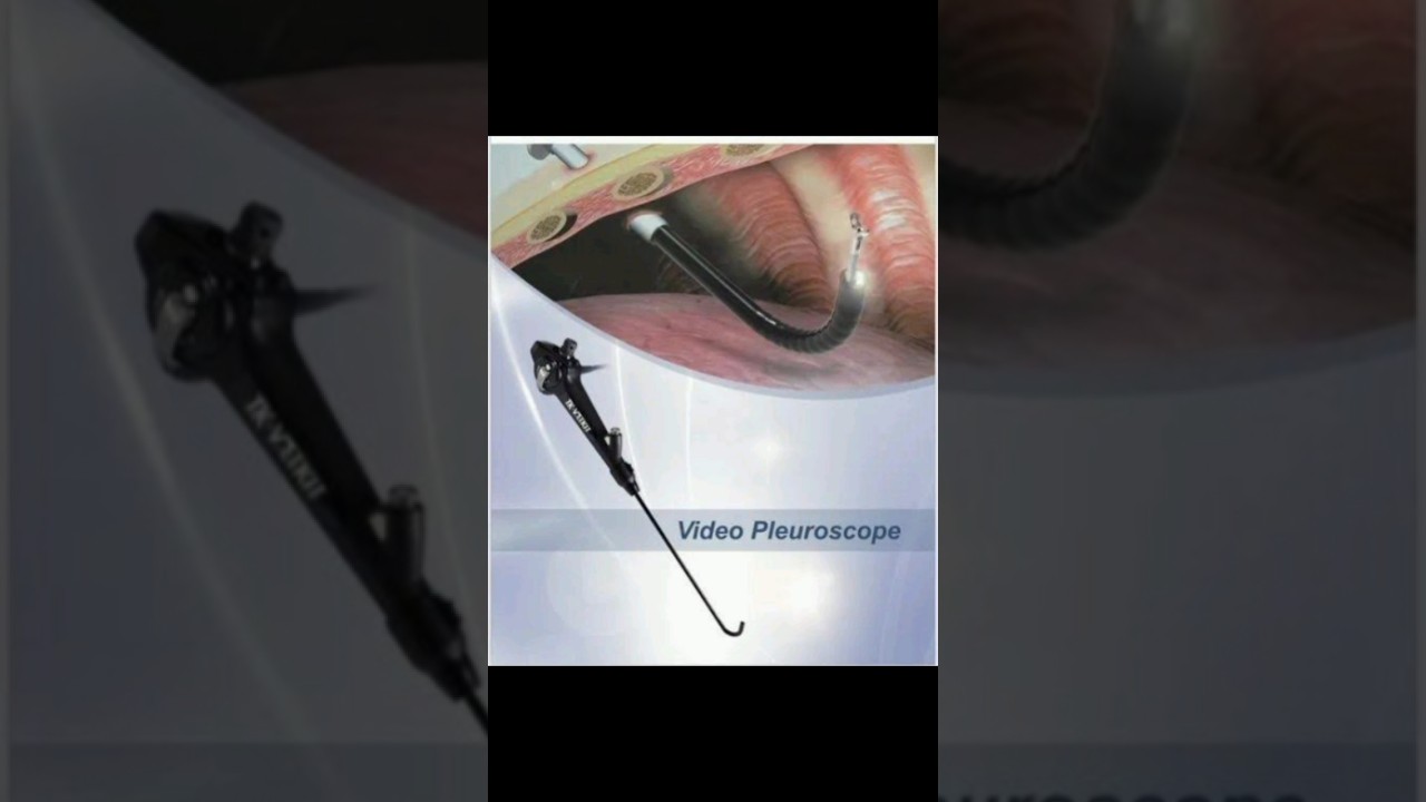 Medical Thoracoscopy/Pleuroscopy #pleuraleffusion #pneumothorax #tumortreatment #pleural