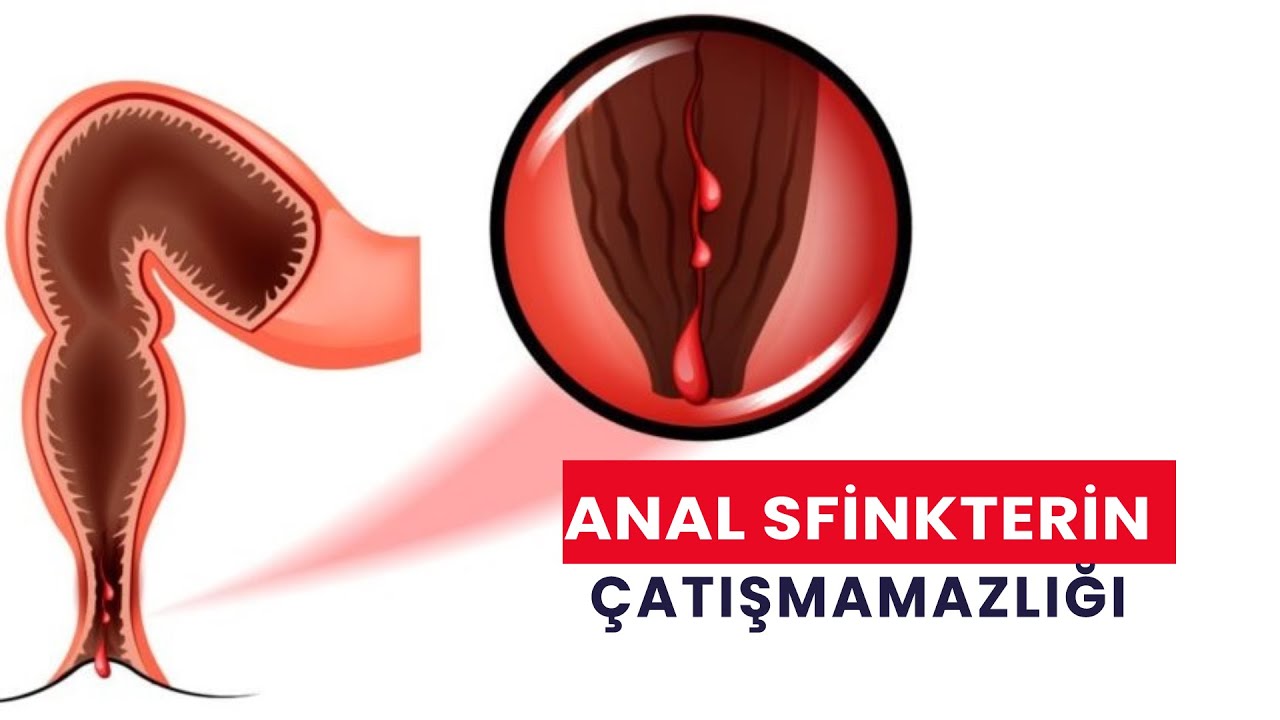 ANAL SFİNKTERİN ÇATIŞMAMAZLIĞI NƏDİR?   | Nəcis ve qaz saxlaya bilməmək