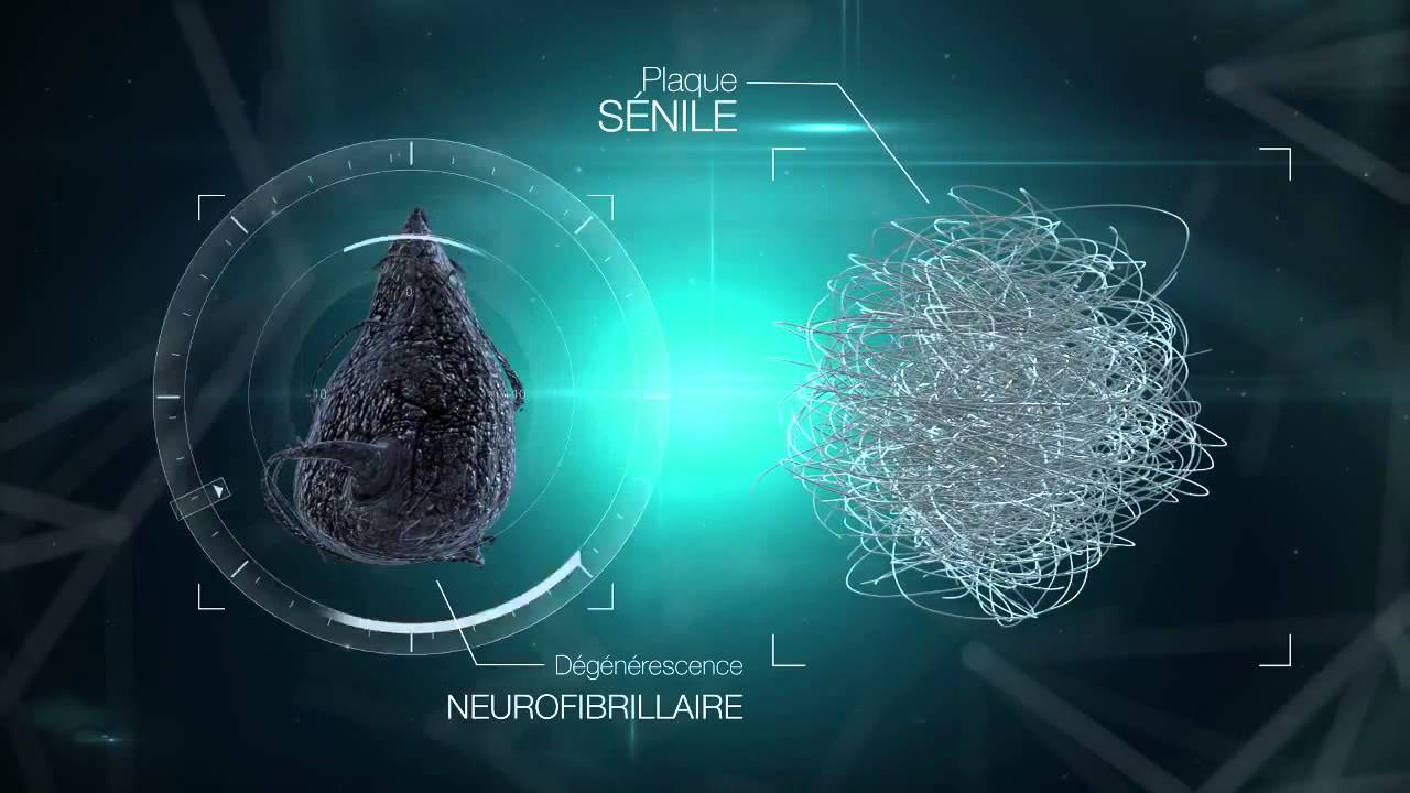 Qu'est ce qu la maladie d'Alzheimer