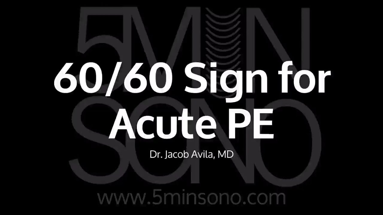 60/60 Sign for Acute PE