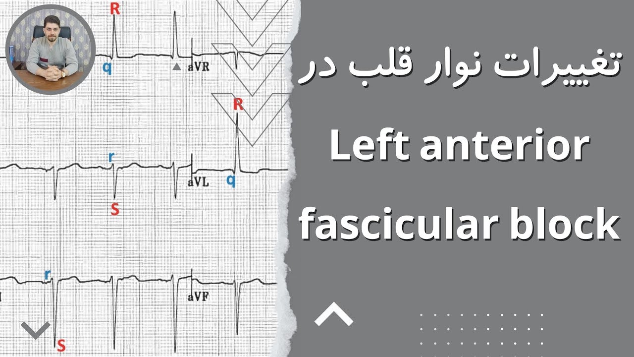 دوره آموزش نوار قلب | قسمت بيست و نهم | Left anterior fascicular block تغييرات الكتروكارديوگرام در