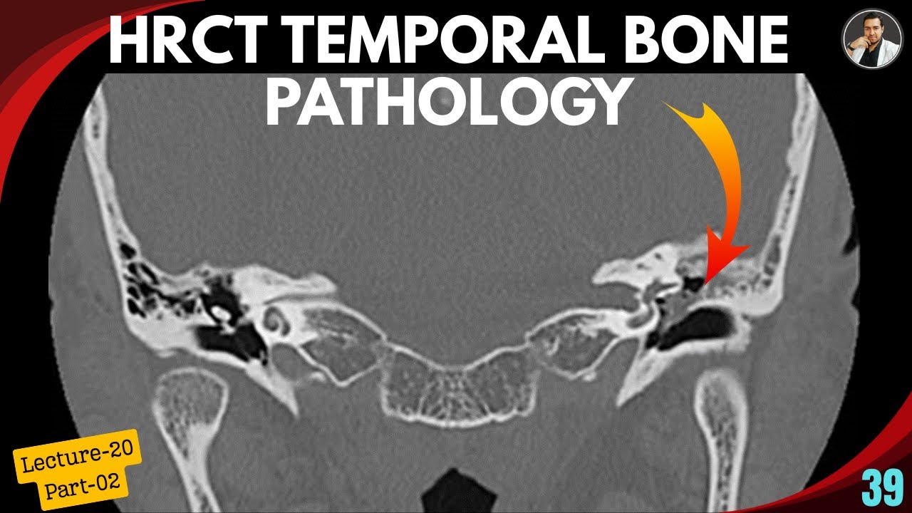 HRCT Temporal Bone Pathology - Lecture:20 (Part-02) |Tutorial-39| Cholesteatoma | Glomus Tympanicum|