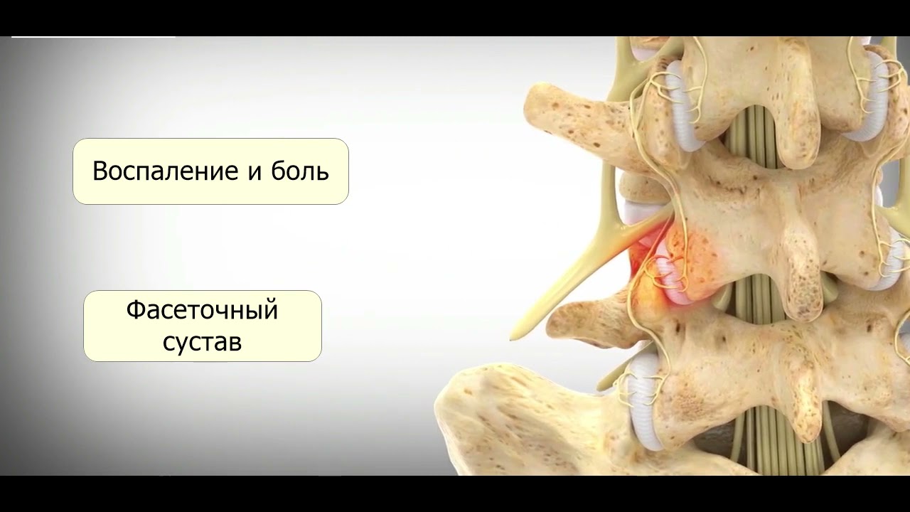 Спондилоартроз/фасеточный синдром: подробнее о факторах  истончения хрящей позвоночника.