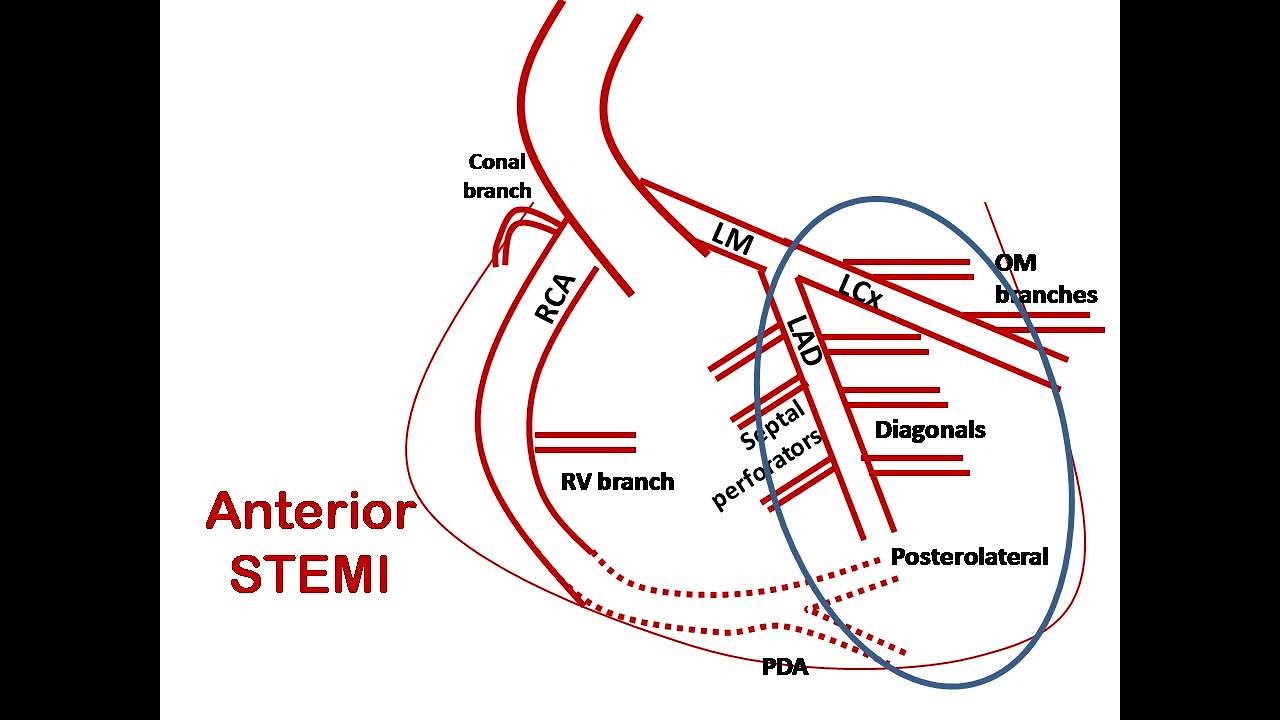 ECG course: Culprit in Anterior STEMI, Dr. Sherif Altoukhy