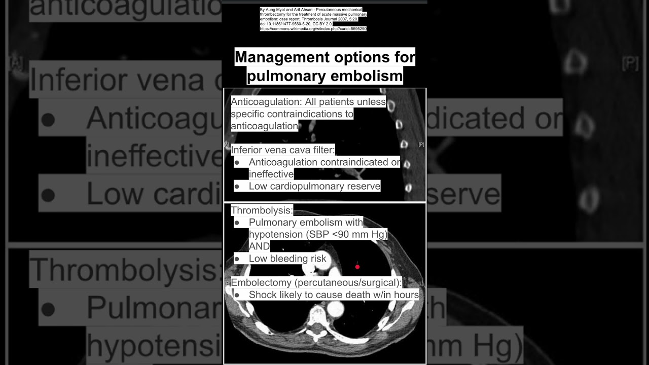 Management options for pulmonary embolism