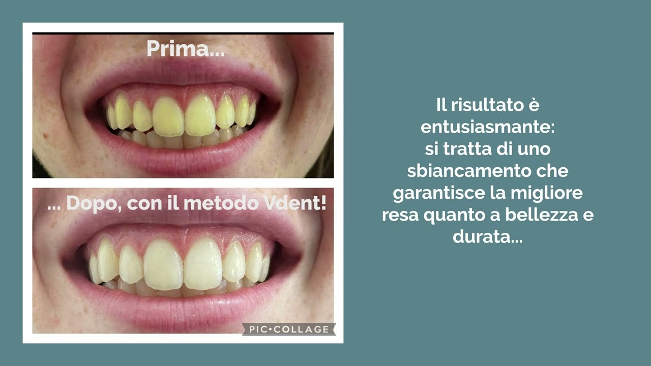 Sbiancamento Dentale: prima e dopo!