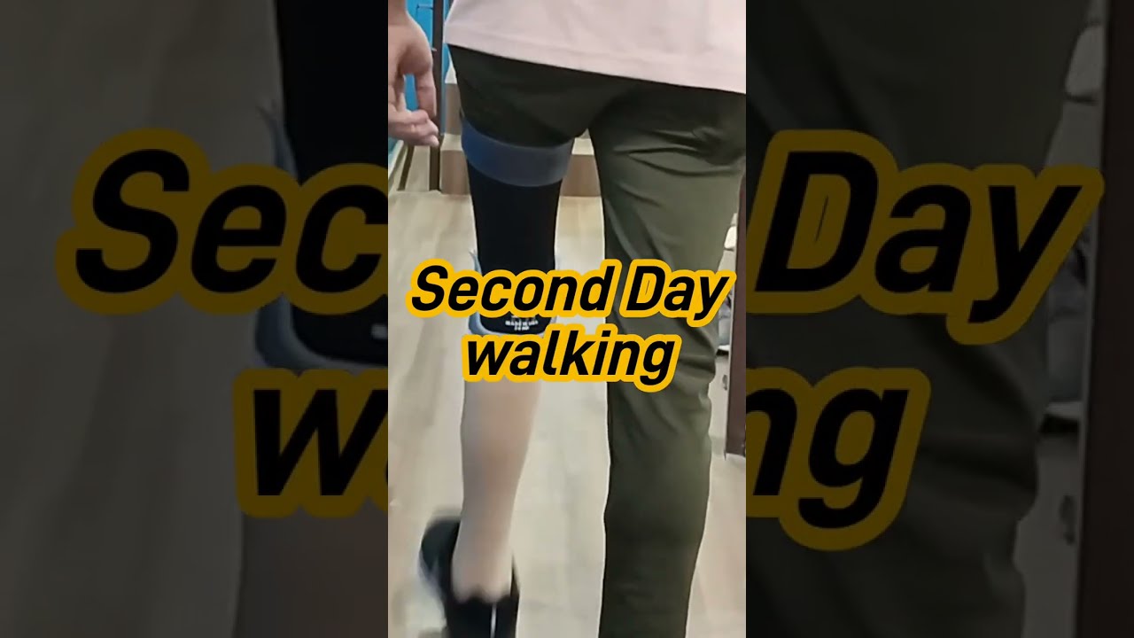 Below Knee Amputation Walking  with Prosthetic Leg for the first time after 15 years finally !!!