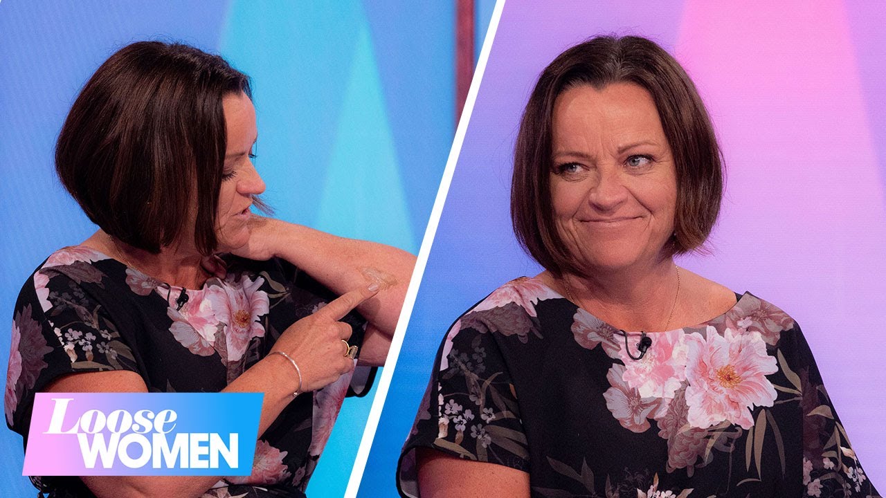Martine Wright MBE Marks 20 Years Since Surviving the 7/7 Bombings | Loose Women