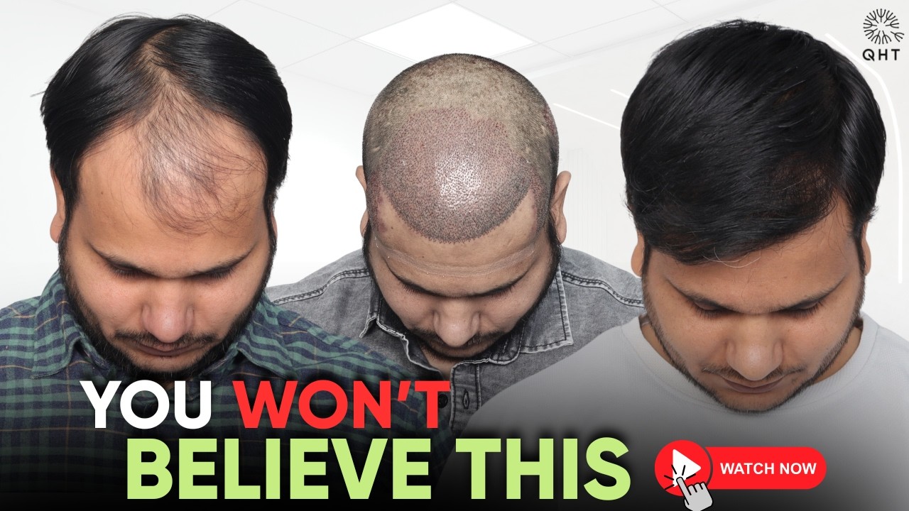 Hair Transplant in Nashik  (HX-GQQA) | Best Results & Cost of Hair Transplant in Nashik