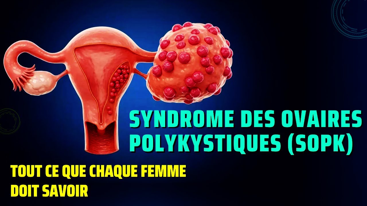 Le syndrome des ovaires polykystiques (SOPK) est l’un des troubles hormonauxplus méconnus !