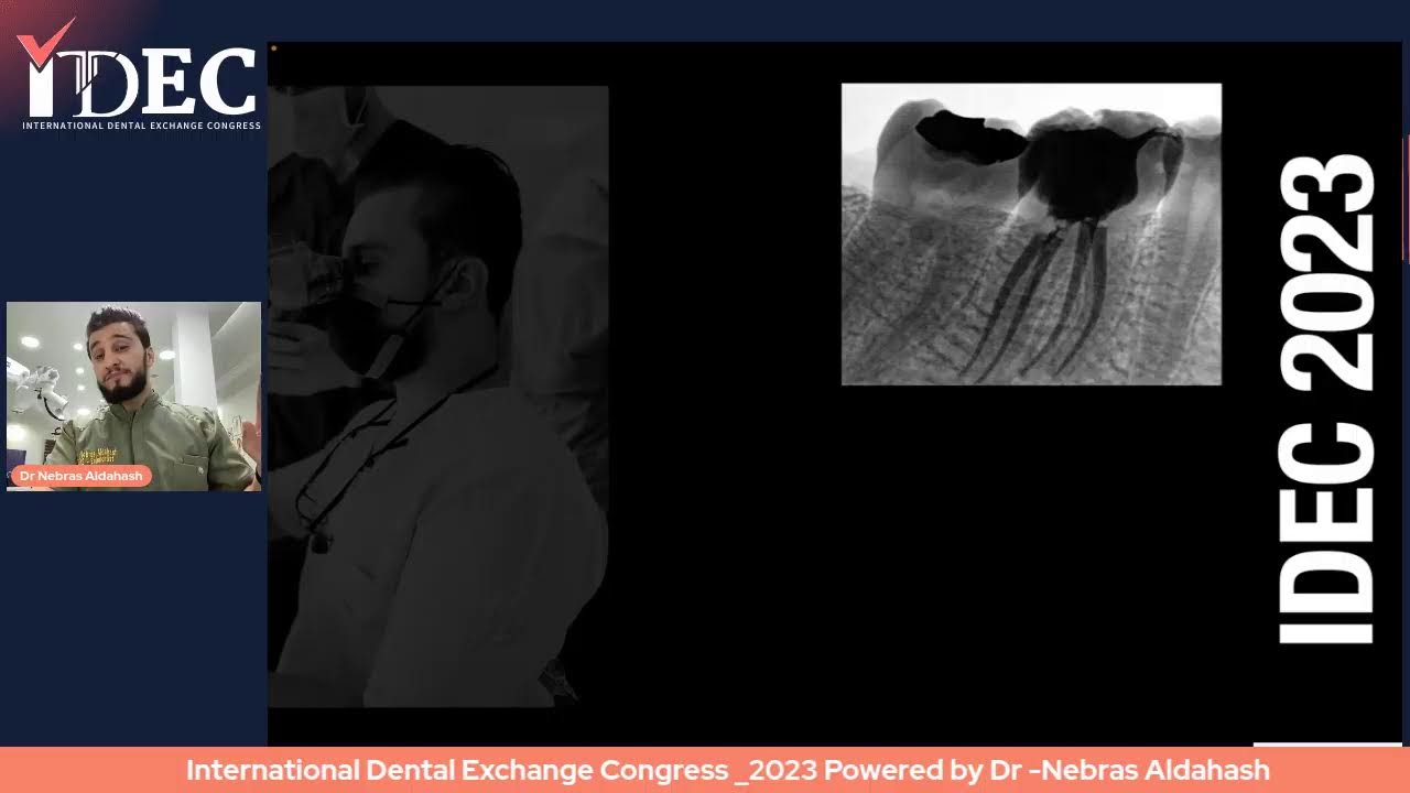 MANAGEMENT OF CALCIFIED & BLOCKED CANALS , Nebras Aldahash 🇱🇾