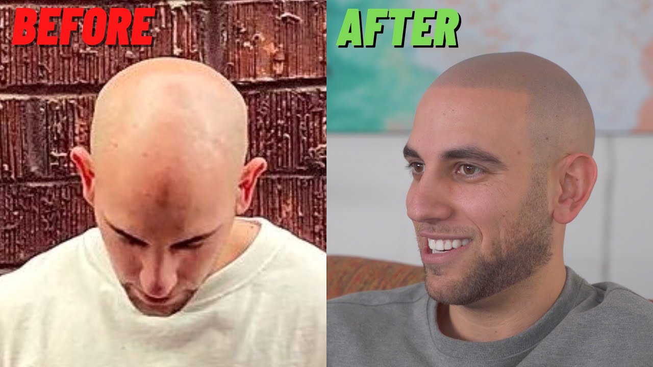 EPIC Scalp Micropigmentation Transformation in Los Angeles, CA