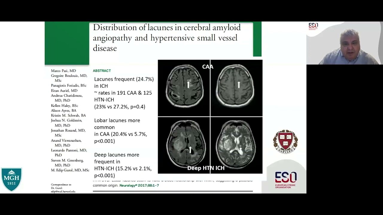 Lacunar Ischaemic Stroke - Clinical Perspectives