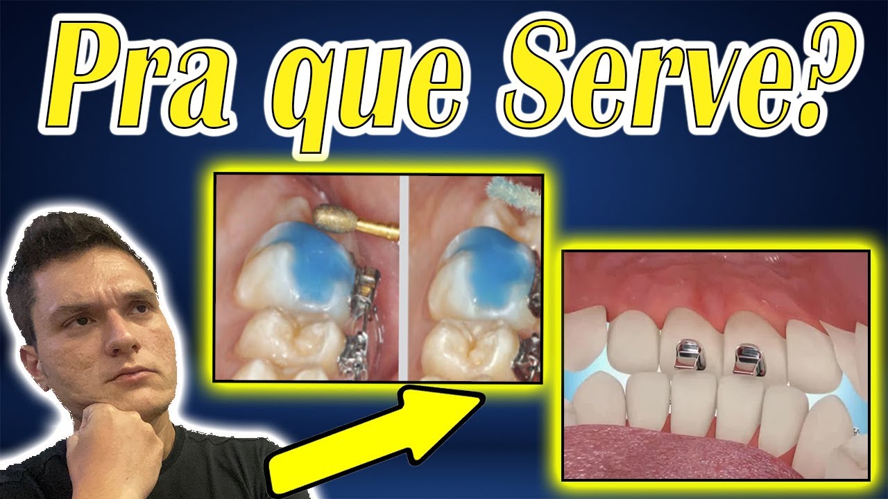 LEVANTE DE MORDIDA (BATENTE EM ORTODONTIA) | PRA QUE SERVE? | DÓI MUITO?