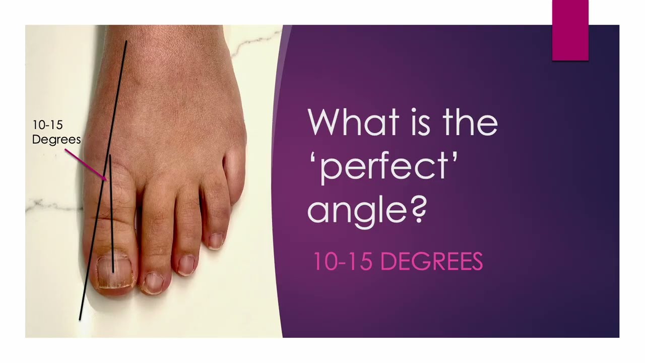 Big toe alignment after bunion surgery