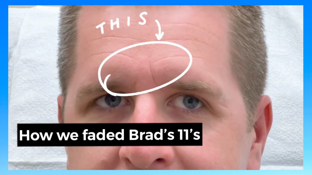 Brotox for the 11's (aka glabella or frown lines)