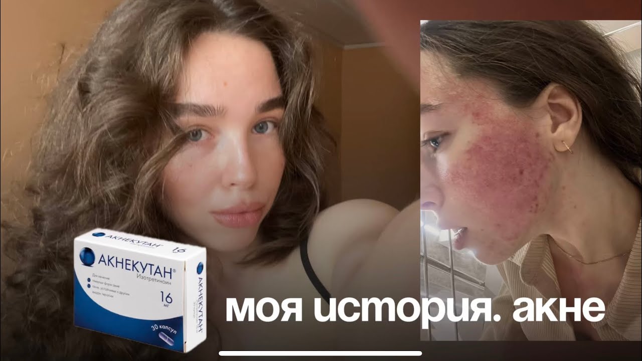 МОЯ ИСТОРИЯ АКНЕ. АКНЕКУТАН. ЦЕНЫ