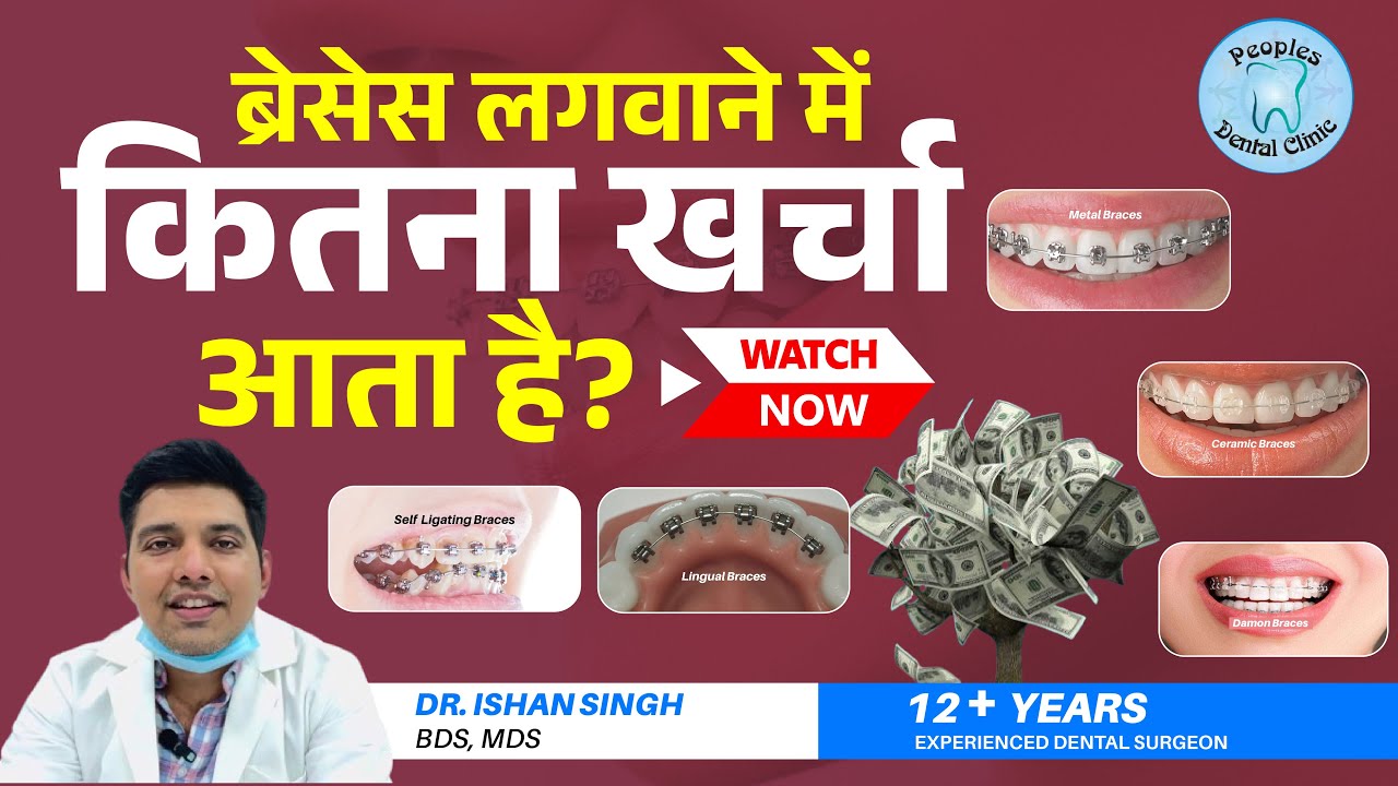 Cost of Braces Treatment in India | Metal Braces Cost | Ceramic Braces Price | Dr. Ishan Singh