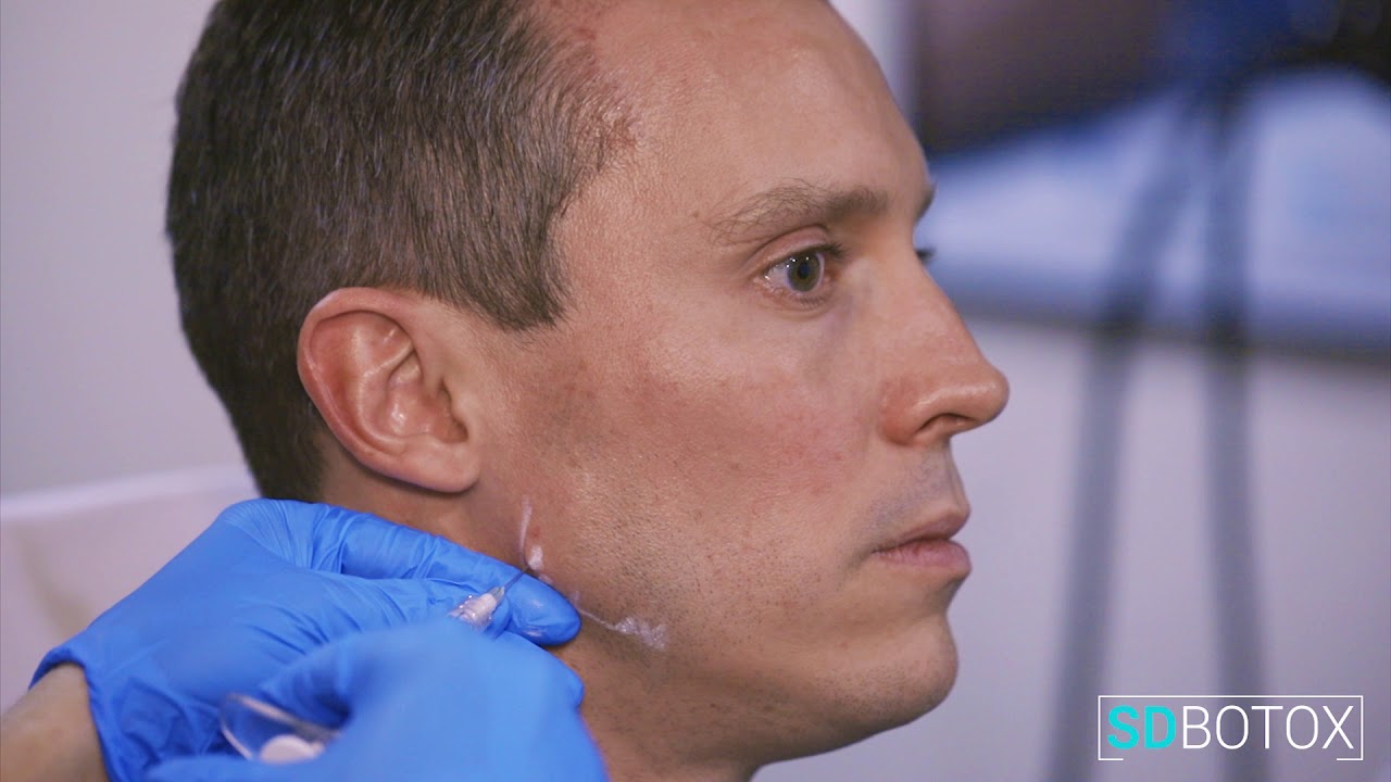 Male Jawline Enhancement (Radiesse) - SDBotox