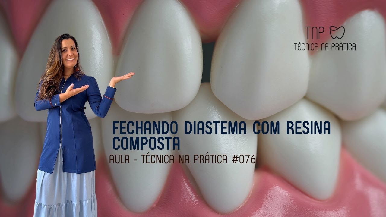 Fechamento de Diastema com Resina Composta - TNP(#076)