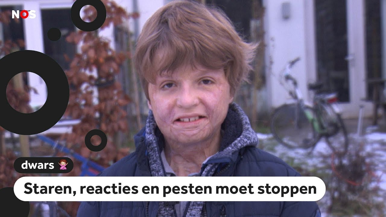 Fender baalt van opmerkingen over zijn brandwonden