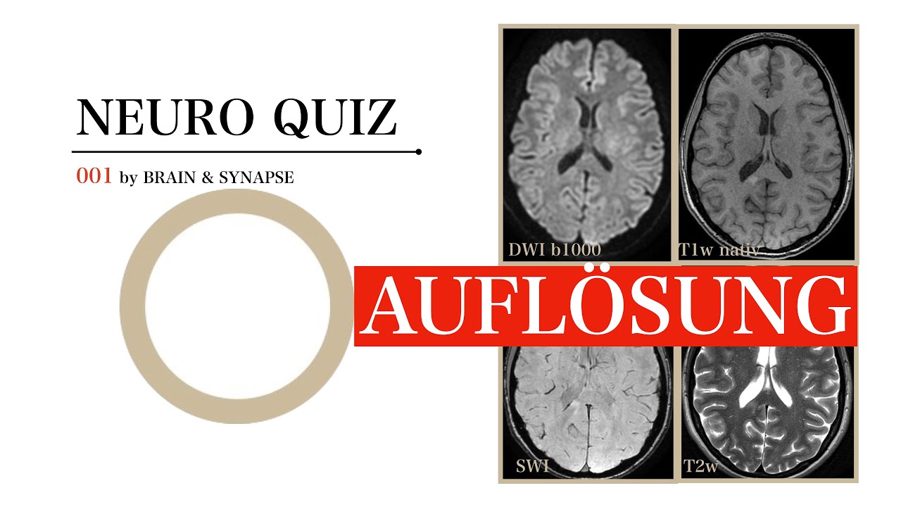 Neuro Quiz 001 I Auflösung I Multiple Sklerose I Neuroradiologie I Gehirn I  Brain & Synapse