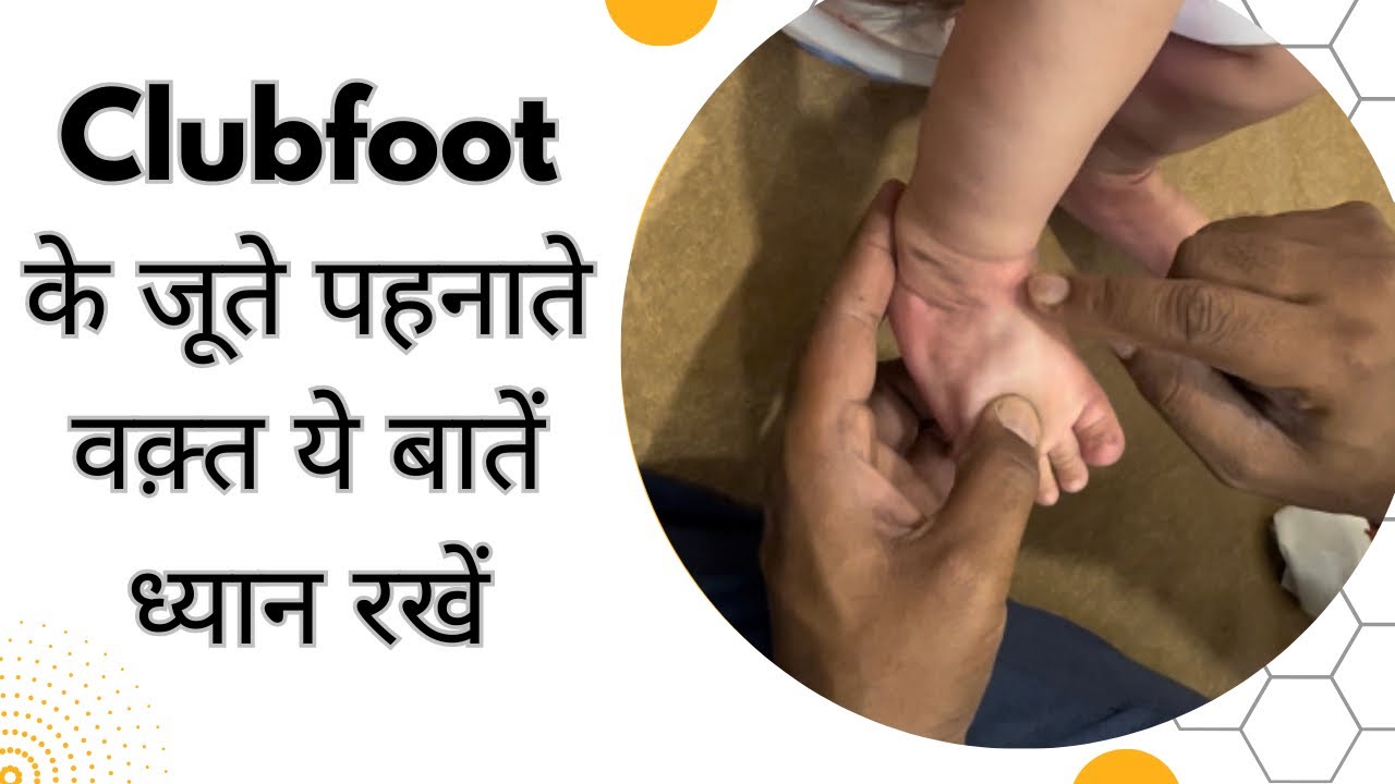 clubfootके जूते पहनाते वक्त क्याक्या दिक्कत आती है