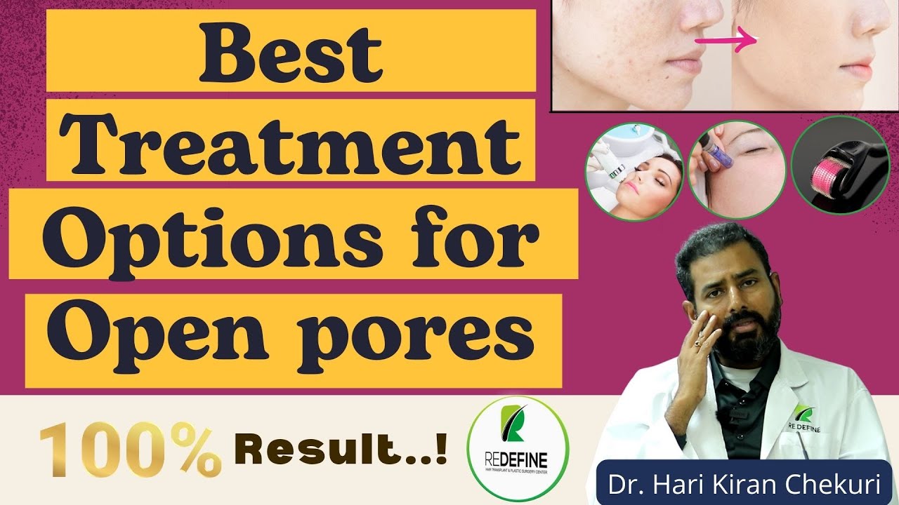 How to treat OPEN PORES | Enlarged Pores - Laser Options || Redefine Plastic Surgery Center