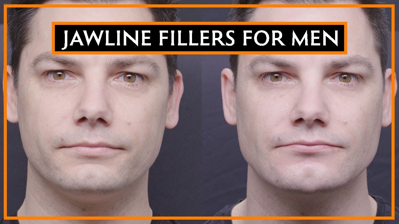 How Dermal Fillers Can Change Your Jawline