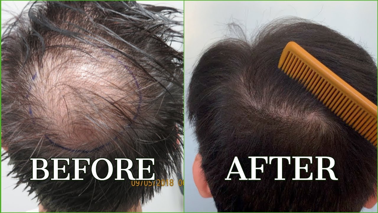 Hair Transplant for CROWN area - BEFORE & AFTER - Dr. Sean Behnam - Los Angeles