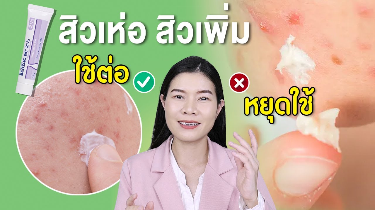 ใช้เบนแซคสิวเห่อจริงหรอ? สิวอุดตัน สิวอักเสบขึ้นเพิ่ม ทายารักษาสิวกลัวหน้าเห่อ | แนน Sister Nan