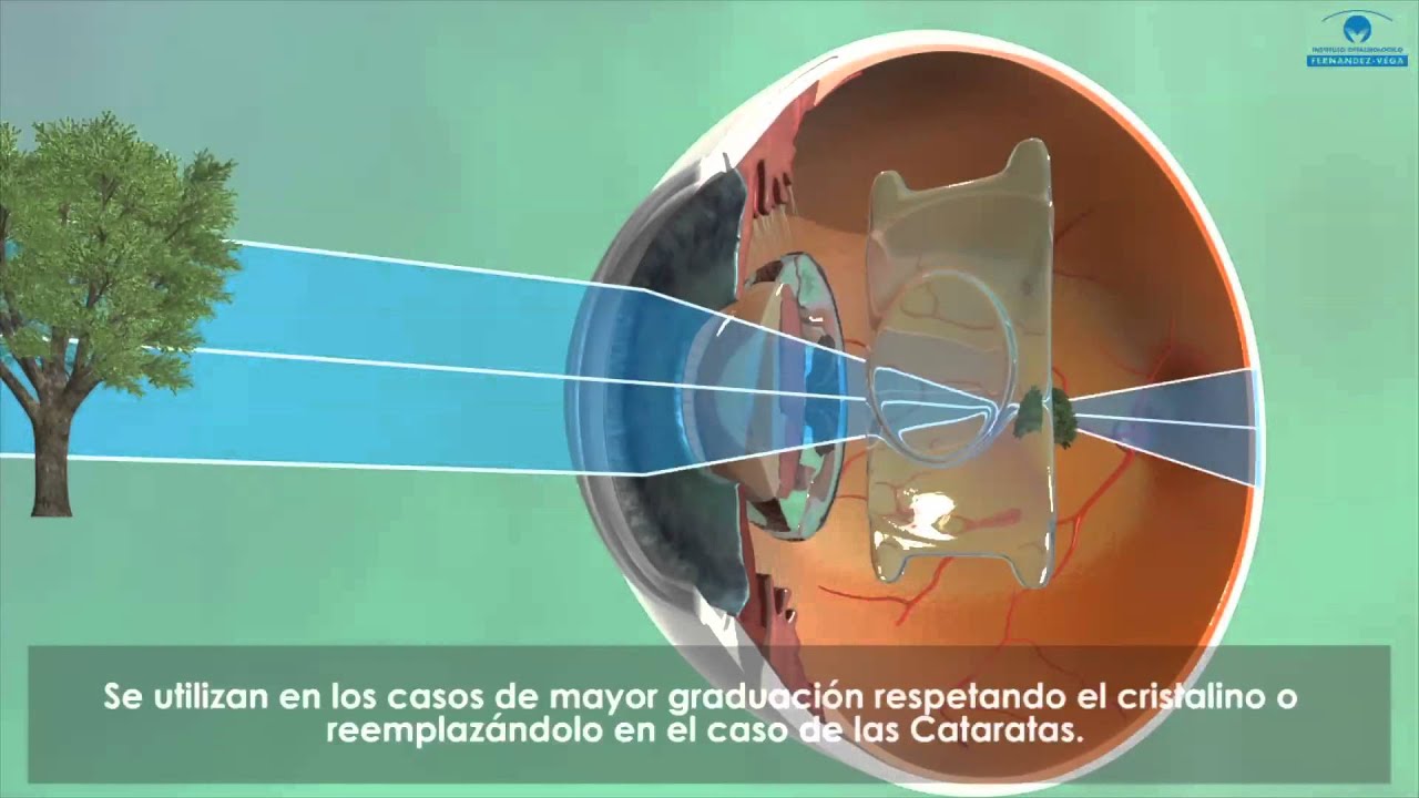 Cirugía Refractiva