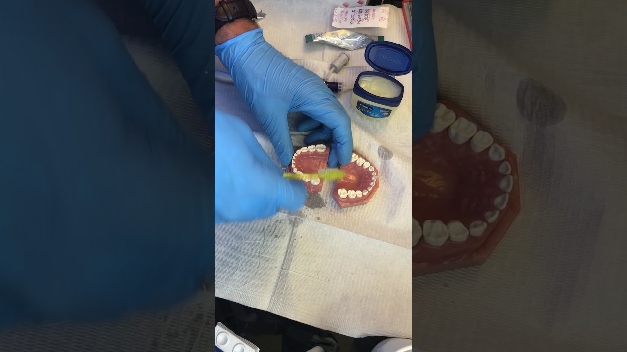 Glass ionomer dental sealant - MacIntyre finger technique (Riva)